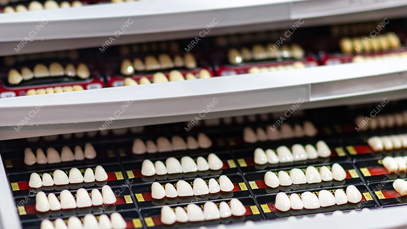 No-Prep Veneers